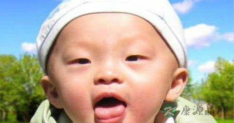 【鹅口疮患儿的护理事项】鹅口疮护理注意事项