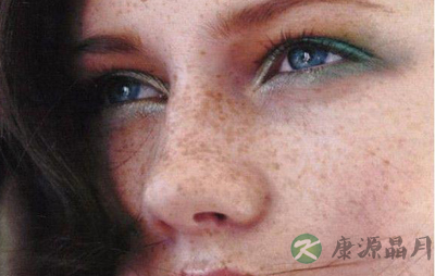 父母有雀斑女儿遗传几率更大 5-10岁开始显现