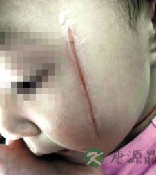 3岁女童幼儿园被同学划破脸毁容