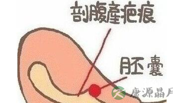 头胎剖宫产二胎犯了难 瘢痕妊娠成“炸弹”