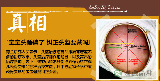 纠正宝宝偏头 头盔治疗并不比自然康复效果好