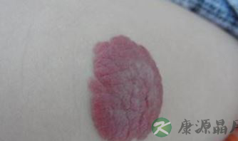 英女婴额头现心形胎记 开心时胎记会变红
