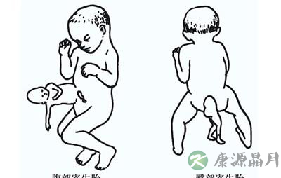 女子产下胎中胎 “寄生胎”十分罕见