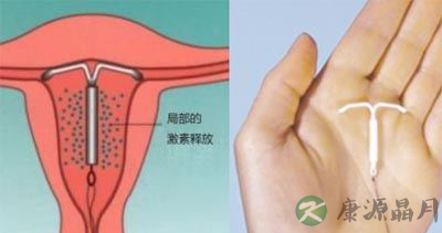 生二胎急不得 取环后等半年再造人