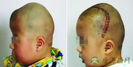 男婴颅骨似外星人 医生为其拼好颅骨