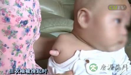 深圳女子产二胎缺右臂 排畸检查该注意什么？