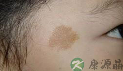 宝宝额前现心型胎记 出生在情人节