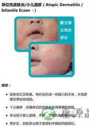 新生儿常见皮肤问题护理