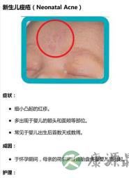 新生儿常见皮肤问题护理