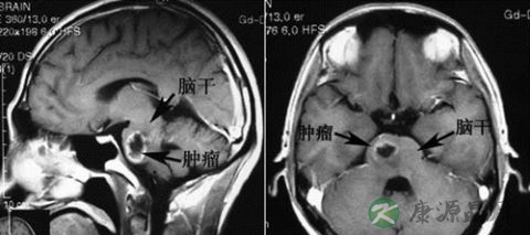中国＂小鸟叔＂病逝 恶性肿瘤成儿童第二大死因