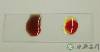 血型变了!女童2岁半时验血是B型5岁时成A型