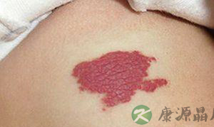 英女婴额头现心形胎记 开心时胎记会变红