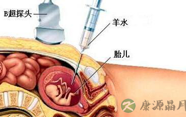 高龄孕妇产检 最好做一下“羊水穿刺”