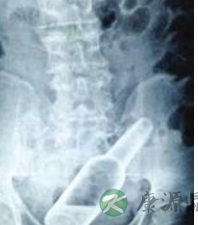 13岁男孩因好奇将玻璃瓶塞入肛门