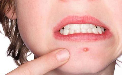 下巴长痘痘是什么原因引起的呢 下巴长痘痘是什么原因引起的呢