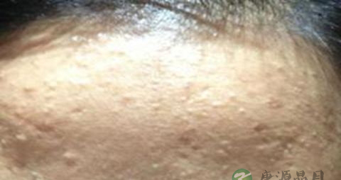 闭口粉刺如何快速消掉