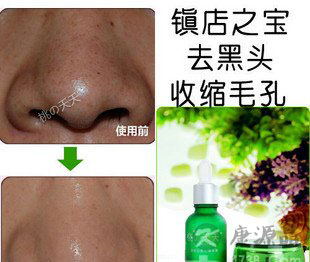 去黑头最有效的产品