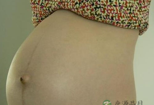 妊娠斑能消除吗 妊娠斑是怎么形成的怎么去除