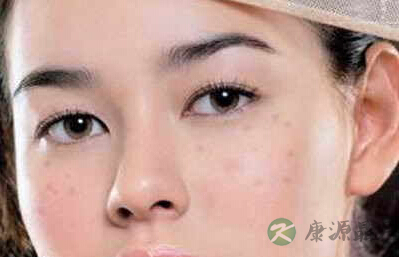 流行的治雀斑的偏方