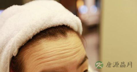 消灭抬头纹的方法_去除抬头纹什么产品