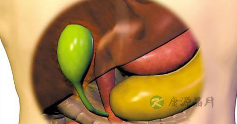 胆结石
