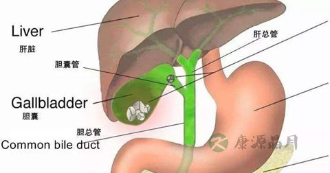 胆结石