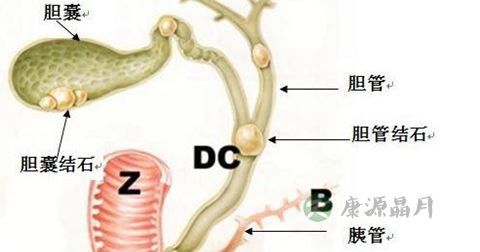 胆囊结石