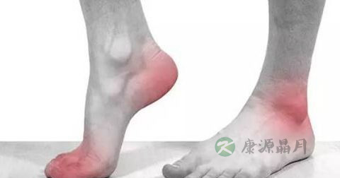 足底筋膜炎