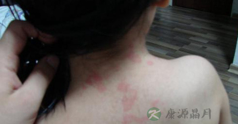 风疹