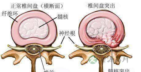 腰椎间盘突出
