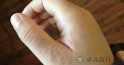 丘疹