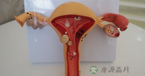 多囊卵巢