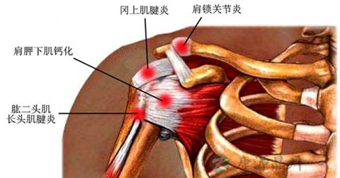 关节脱臼