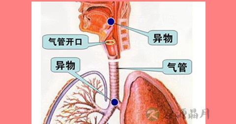 食管异物