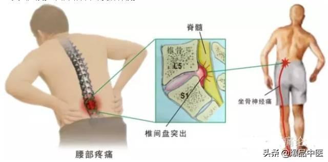 超级实用的腰腿痛临床诊断思维，值得收藏