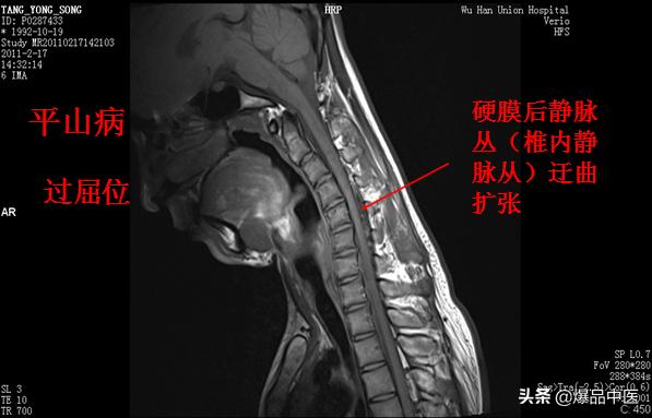 椎管解剖（高清大图）