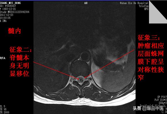 椎管解剖（高清大图）