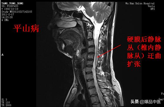 椎管解剖（高清大图）