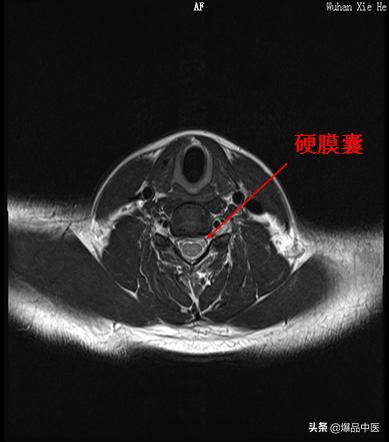 椎管解剖（高清大图）