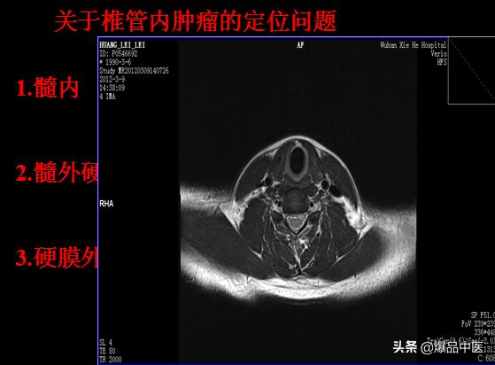 椎管解剖（高清大图）