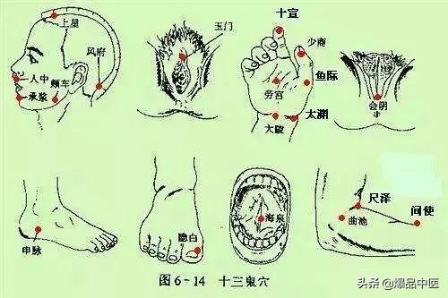 中医针灸“十三鬼穴”