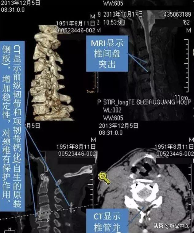 颈椎病诊治十大误区