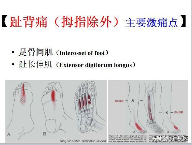 「图文并茂」全身激痛点