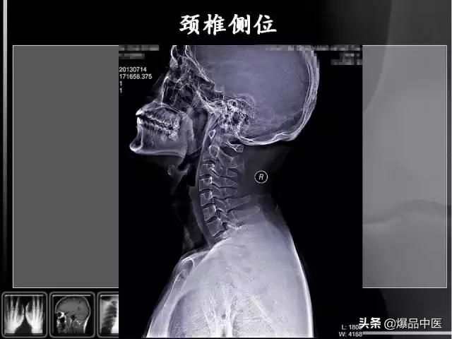 颈椎阅片的基础知识