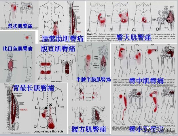 「图文并茂」全身激痛点