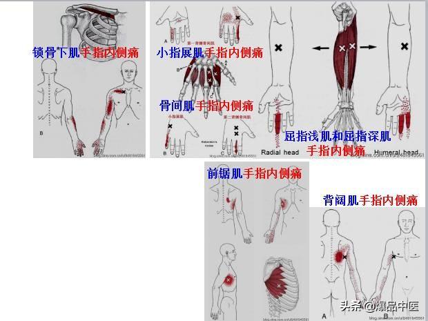 「图文并茂」全身激痛点