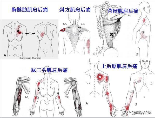 「图文并茂」全身激痛点