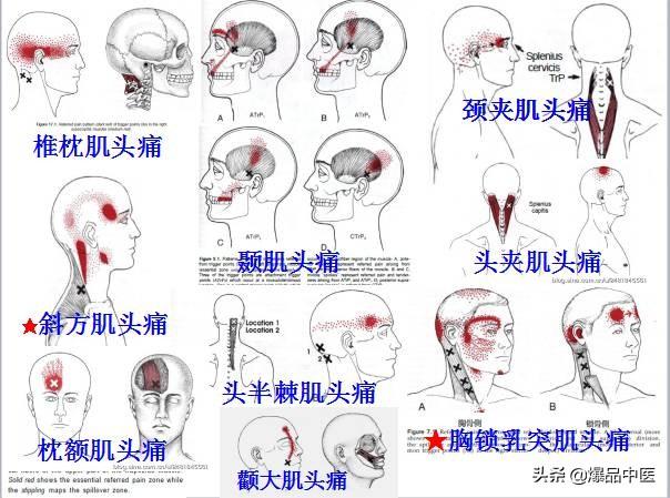 「图文并茂」全身激痛点