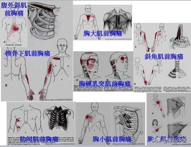 「图文并茂」全身激痛点