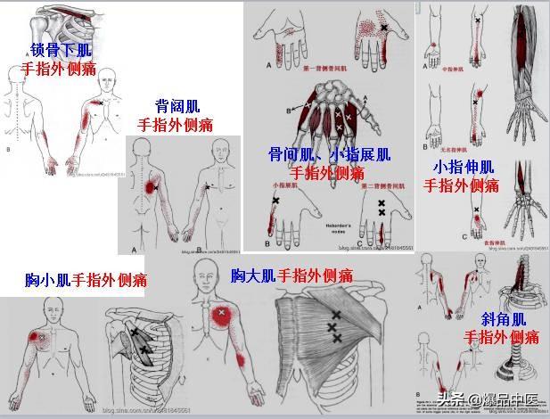 「图文并茂」全身激痛点